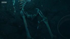 Clip of quote: - Bowed right femur. Probable limp.